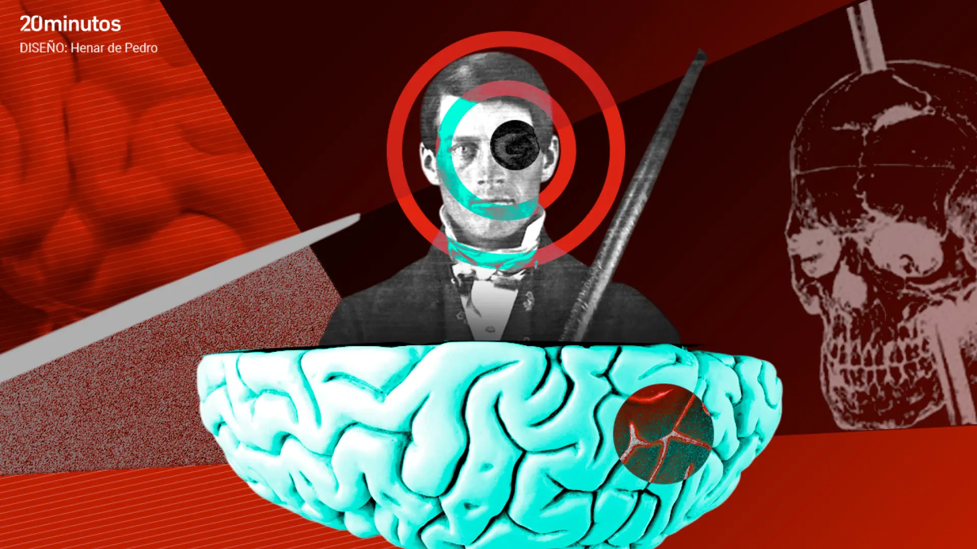 Cráneo de Phineas Gage con barra de hierro que atravesó su corteza prefrontal, clave en neurociencia